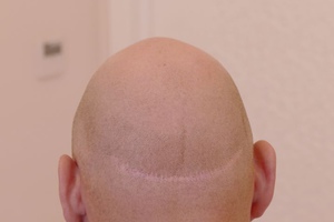 Исправление и удаление татуировки волос